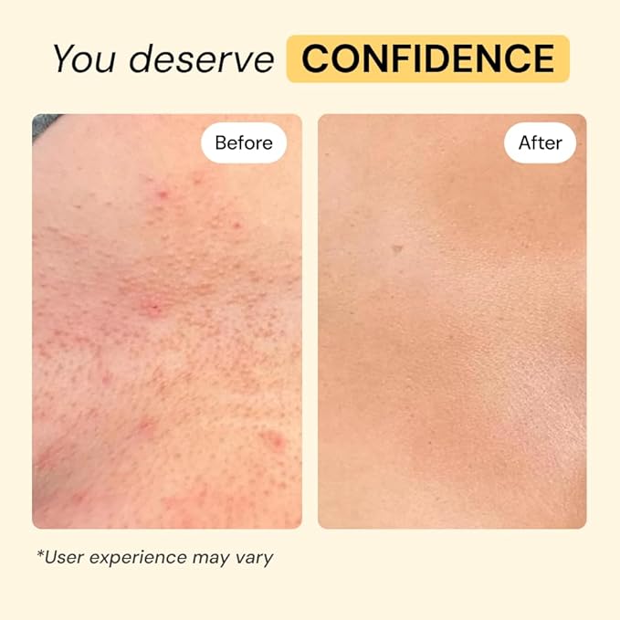 MyMagicHealer Universal Flare Care – Solution for Everyday Skin Flare-Ups | Drawing Salve for Boils & Cysts, Hidradenitis Suppurativa, Folliculitis | Irritated Skin and Chafing Relief 1 oz