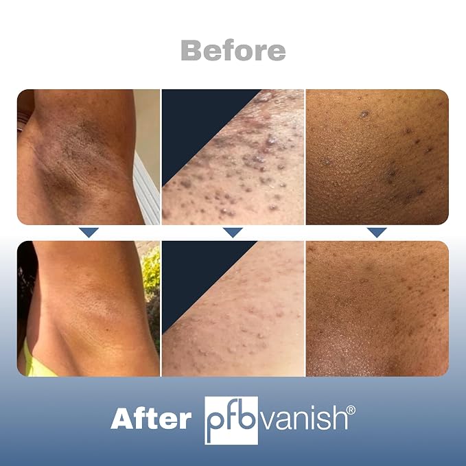 PFB Vanish Chromabright Ingrown Hair Treatment (3.28 oz) – After Shave Soothing Solution Ingrown Hair & Razor Bump Stopper, Relieves & Softens Skin, Dark Spots Remover for Face, Body & Intimate Areas