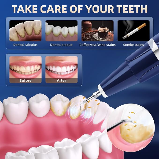 Plaque Remover for Teeth - Tartar Remover for Teeth, Dental Calculus Remover Teeth Cleaning Kit