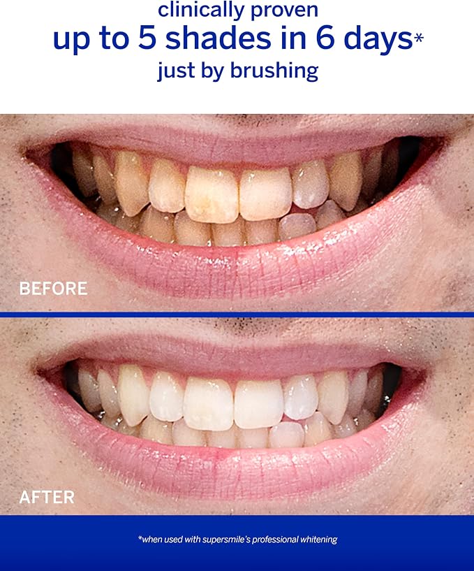 Supersmile Original Mint Whitening Toothpaste, 4.2 Oz, Calprox® + Fluoride | Whitens 3 Shades After 1 Day, Signature Wild Mint Flavor, Veneer Safe, RDA 65 Low Abrasion, Cavity Protection