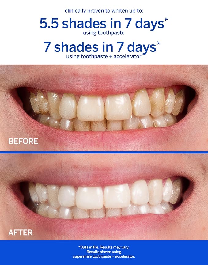 Supersmile Whitening System, Toothpaste + Accelerator, Original Mint | Calprox® 2-Step Whitening System, Whitens Up to 7 Shades in 7 Days, RDA 65 Low Abrasion, Veneer Safe, Cavity Protection